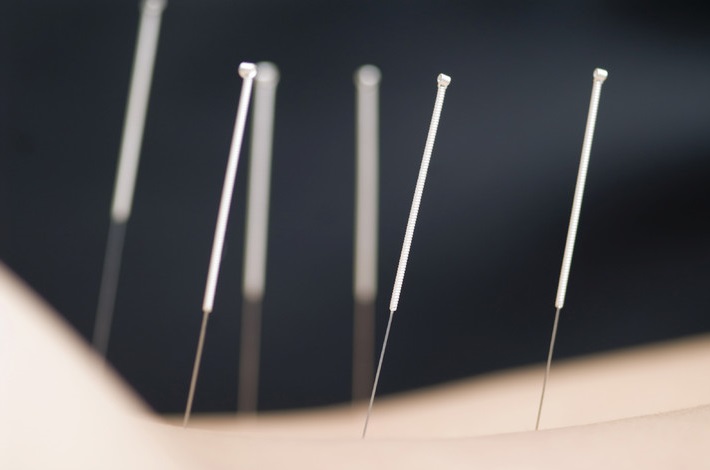 Иглорефлексотерапия Иглорефлексотерапия